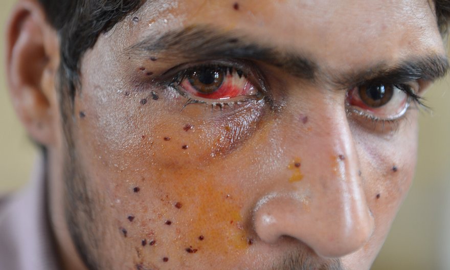 A Kashmiri protester who was shot by Indian security forces in Srinagar, in July 2016. Photograph: Tauseef Mustafa/AFP/Getty Images 